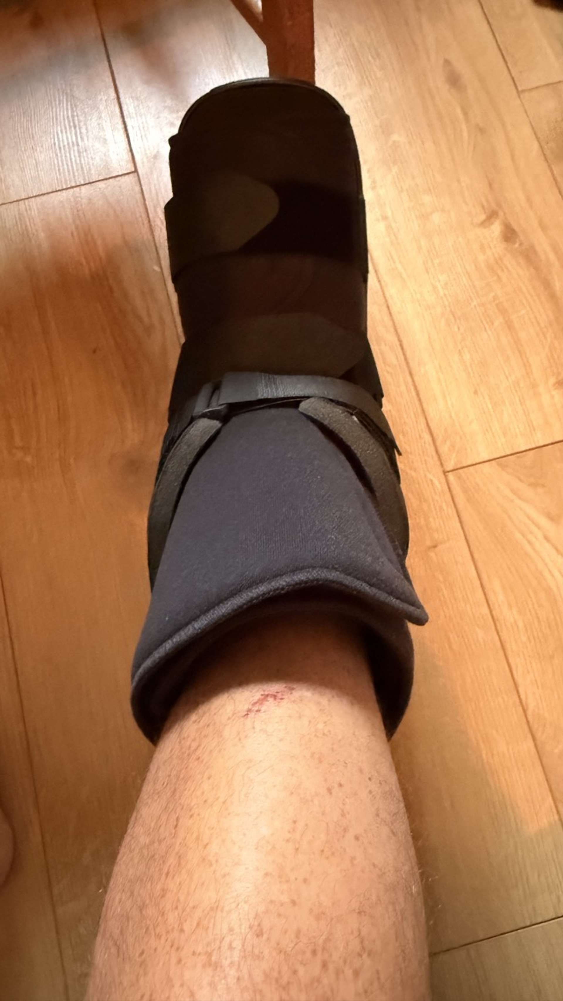 Right foot in cast after severe injury falling off a ladder